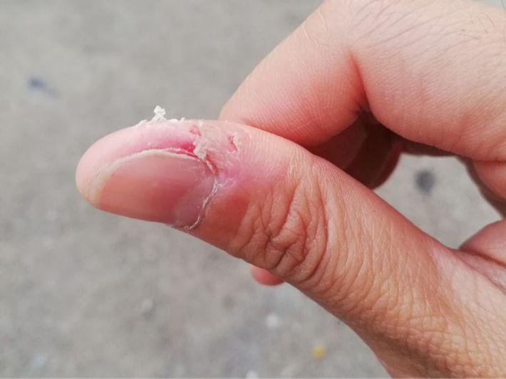 عالجي تشقق الجلد حول الأظافر بهذه الطريقة